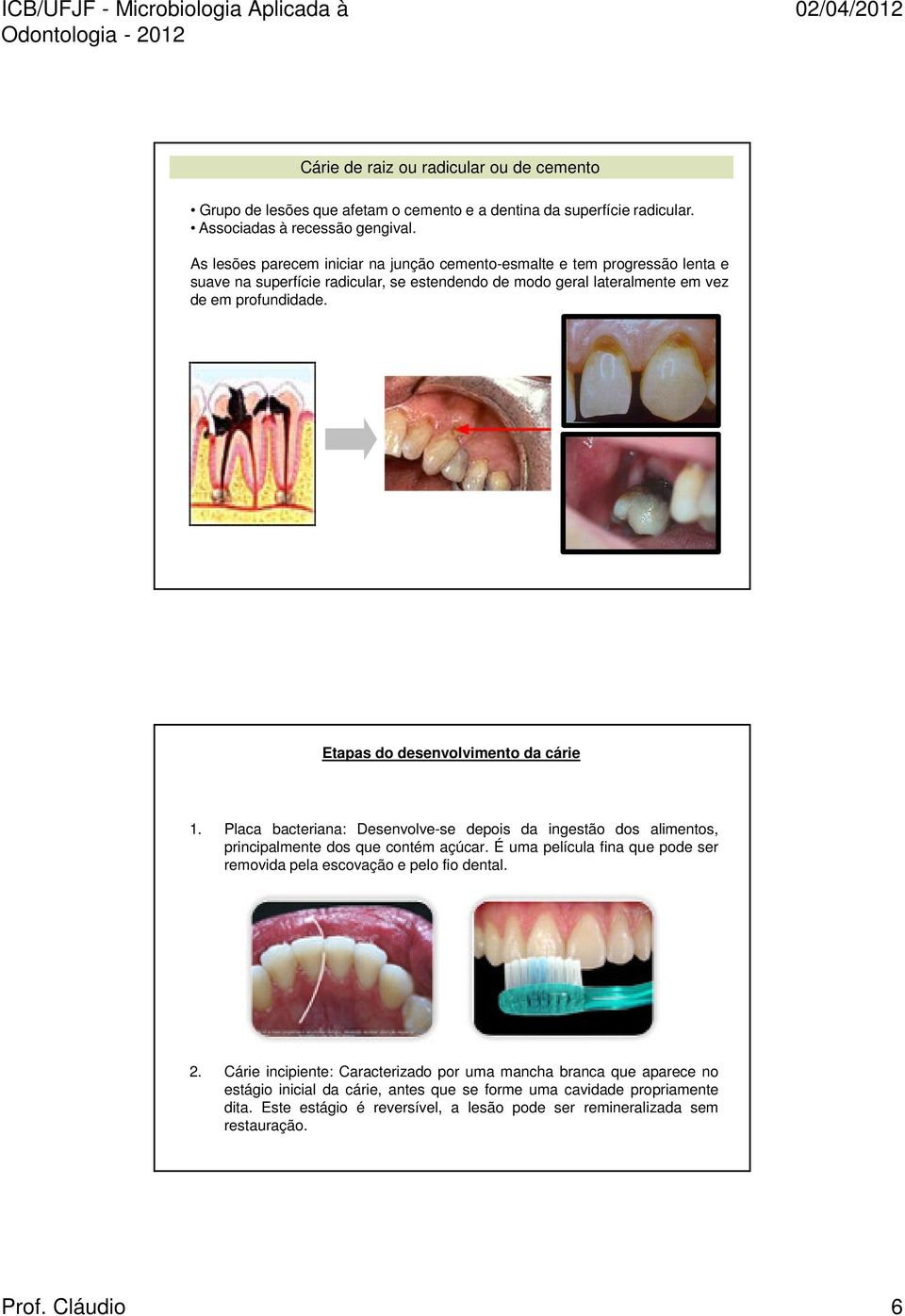 Etapas do desenvolvimento da cárie 1. Placa bacteriana: Desenvolve-se depois da ingestão dos alimentos, principalmente dos que contém açúcar.