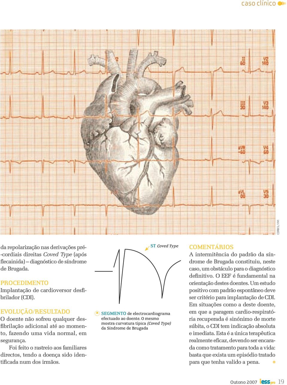 Foi feito o rastreio aos familiares directos, tendo a doença sido identificada num dos irmãos. ST Coved Type SEGMENTO de electrocardiograma efectuado ao doente.