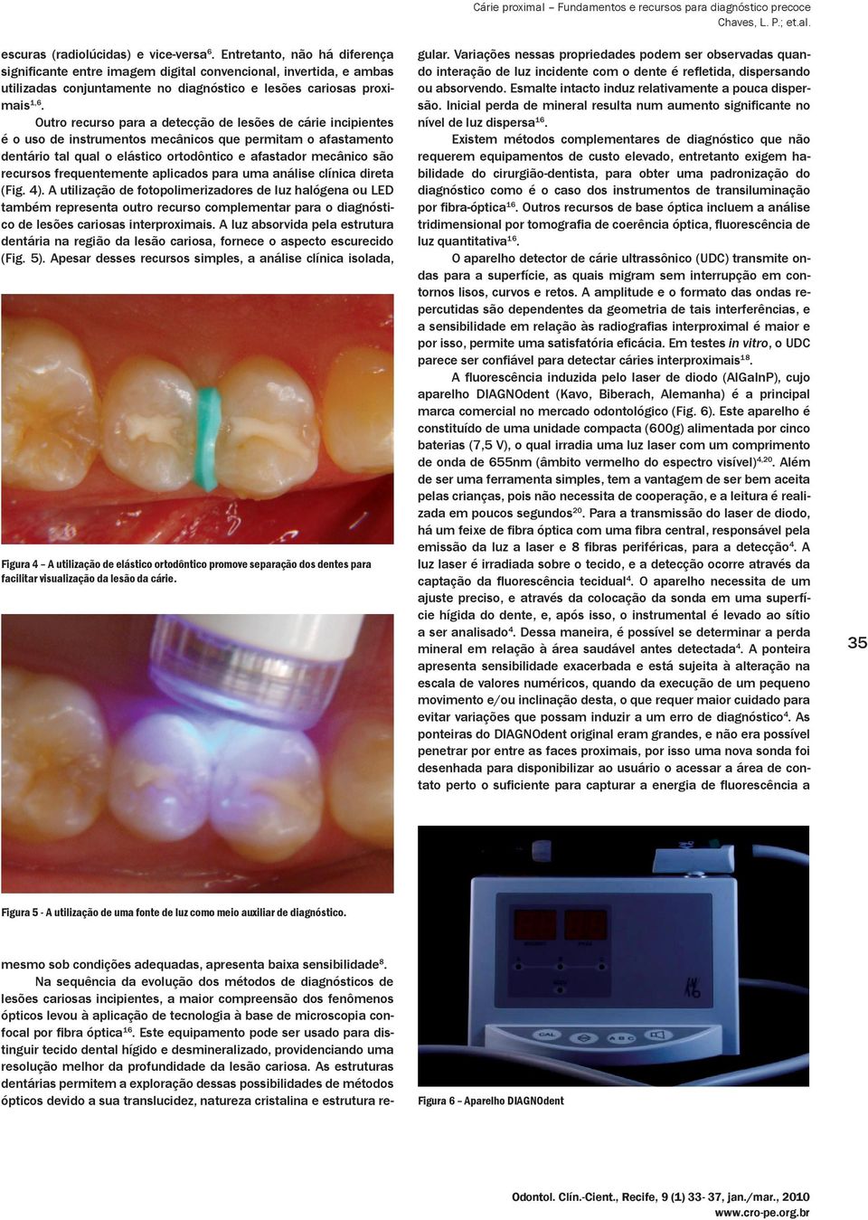Outro recurso para a detecção de lesões de cárie incipientes é o uso de instrumentos mecânicos que permitam o afastamento dentário tal qual o elástico ortodôntico e afastador mecânico são recursos