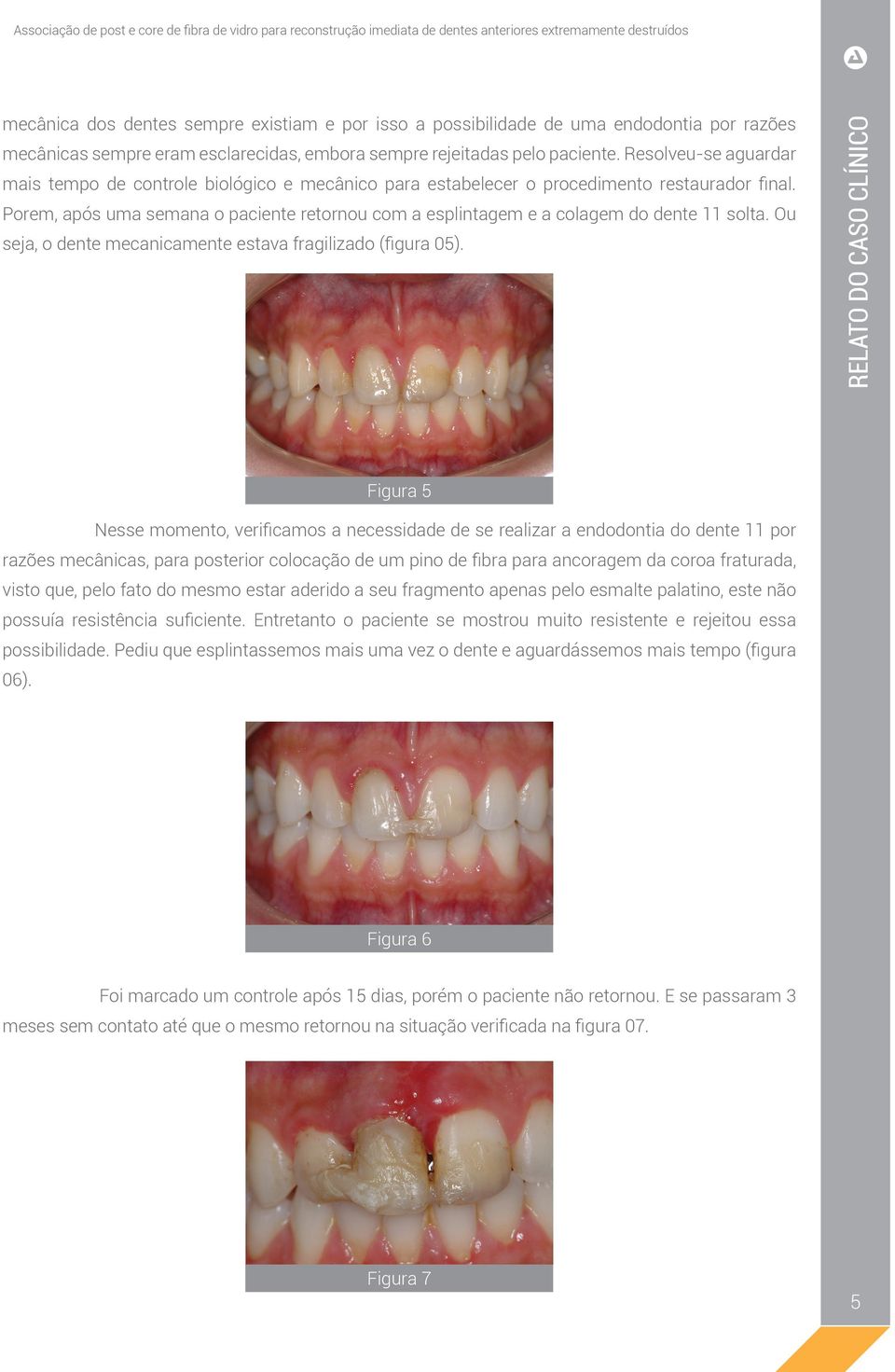 Porem, após uma semana o paciente retornou com a esplintagem e a colagem do dente 11 solta. Ou seja, o dente mecanicamente estava fragilizado (figura 05).