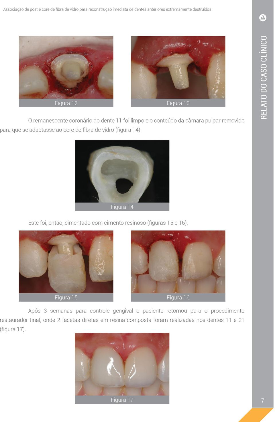 RELATO DO CASO CLÍNICO Figura 14 Este foi, então, cimentado com cimento resinoso (figuras 15 e 16).