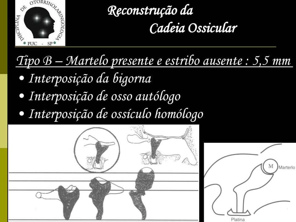 bigorna Interposição de osso