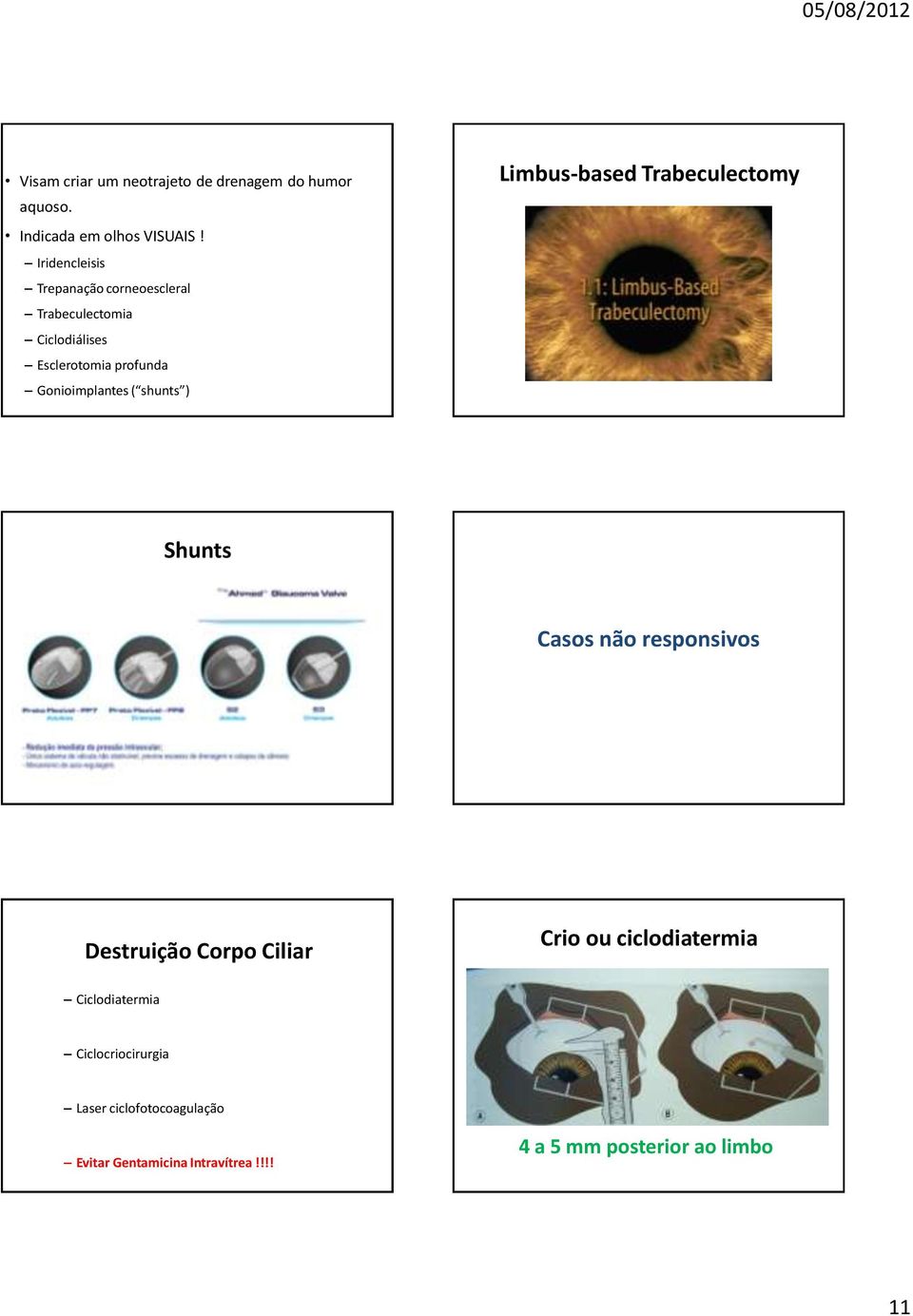 ( shunts ) Limbus-based Trabeculectomy Shunts Casos não responsivos Destruição Corpo Ciliar Crio ou