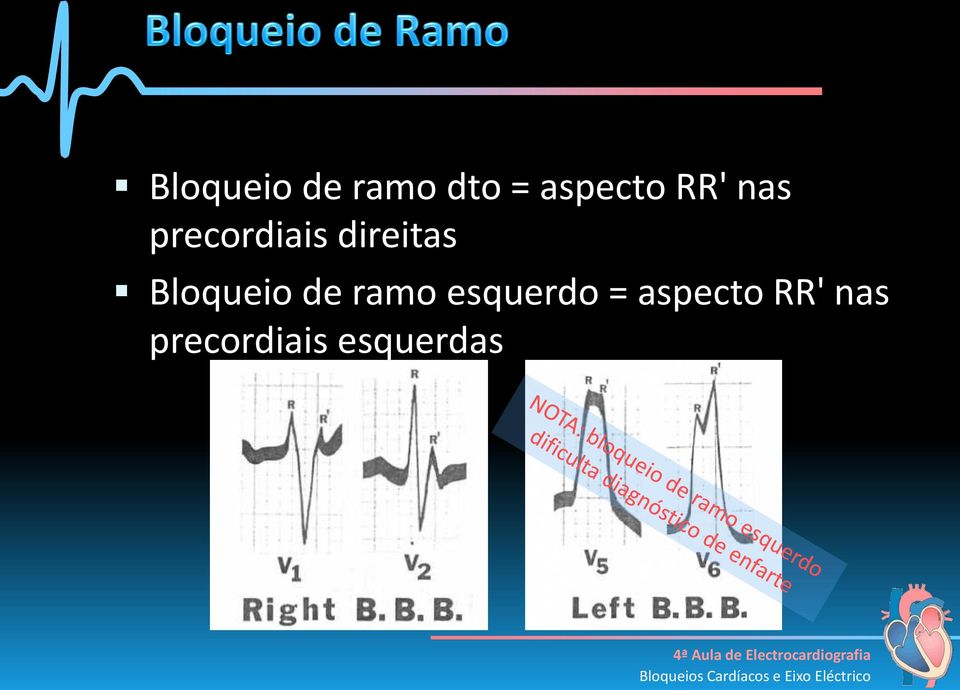 Bloqueio de ramo esquerdo =