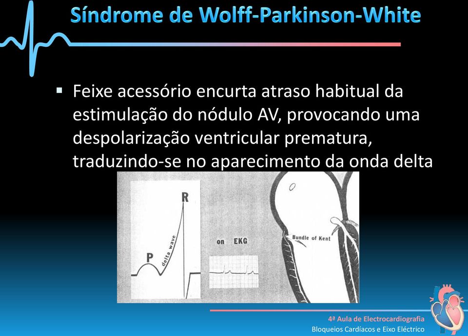 uma despolarização ventricular prematura,