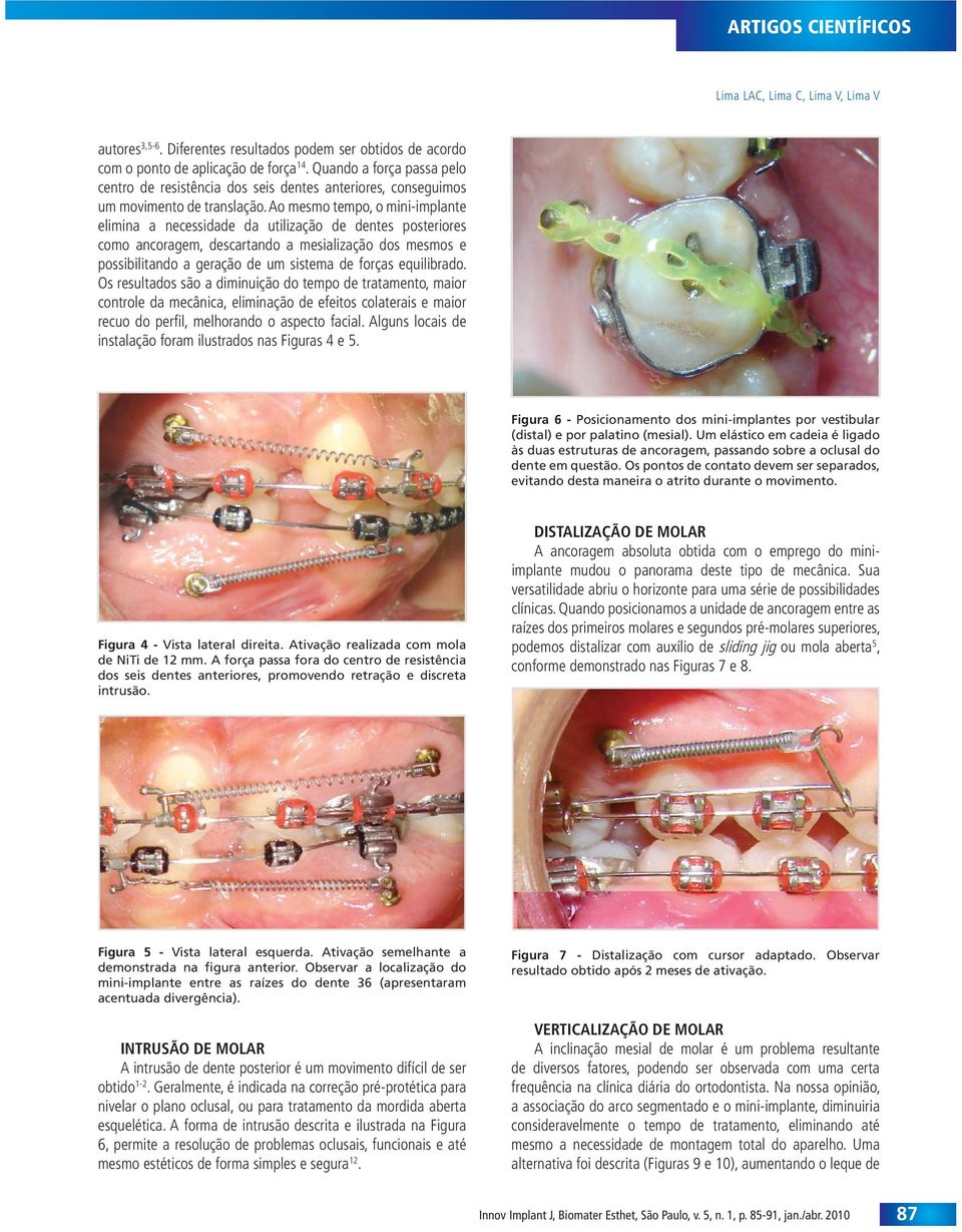 Ao mesmo tempo, o mini-implante elimina a necessidade da utilização de dentes posteriores como ancoragem, descartando a mesialização dos mesmos e possibilitando a geração de um sistema de forças