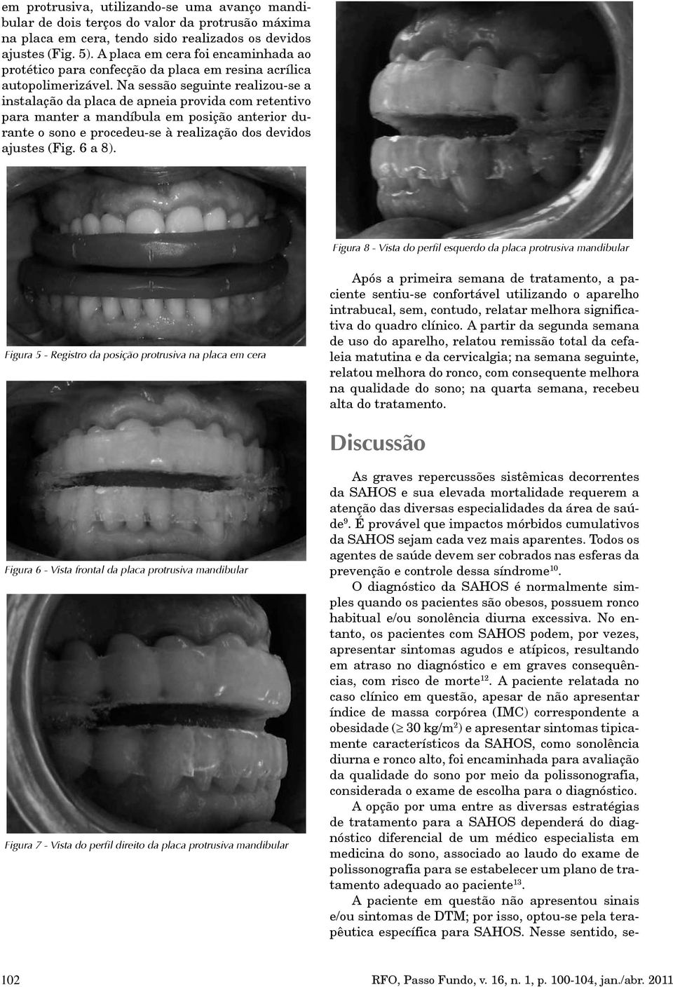 Na sessão seguinte realizou-se a instalação da placa de apneia provida com retentivo para manter a mandíbula em posição anterior durante o sono e procedeu-se à realização dos devidos ajustes (Fig.