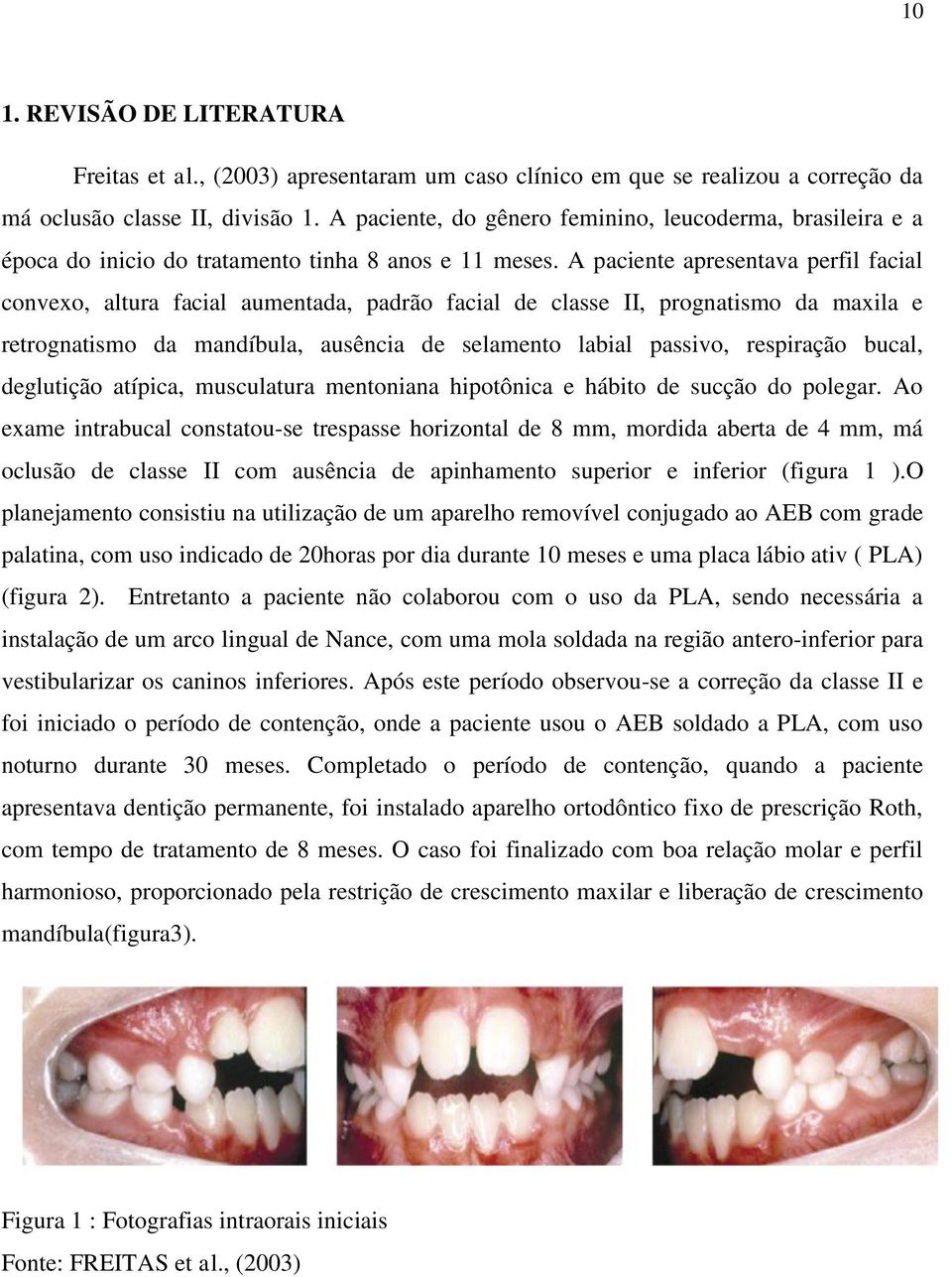 A paciente apresentava perfil facial convexo, altura facial aumentada, padrão facial de classe II, prognatismo da maxila e retrognatismo da mandíbula, ausência de selamento labial passivo, respiração