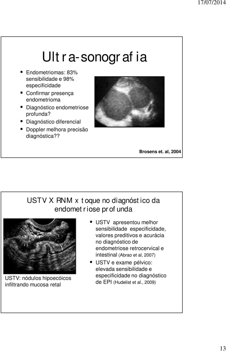 al, 2004 USTV X RNM x toque no diagnóstico da endometriose profunda USTV: nódulos hipoecóicos infiltrando mucosa retal USTV apresentou melhor