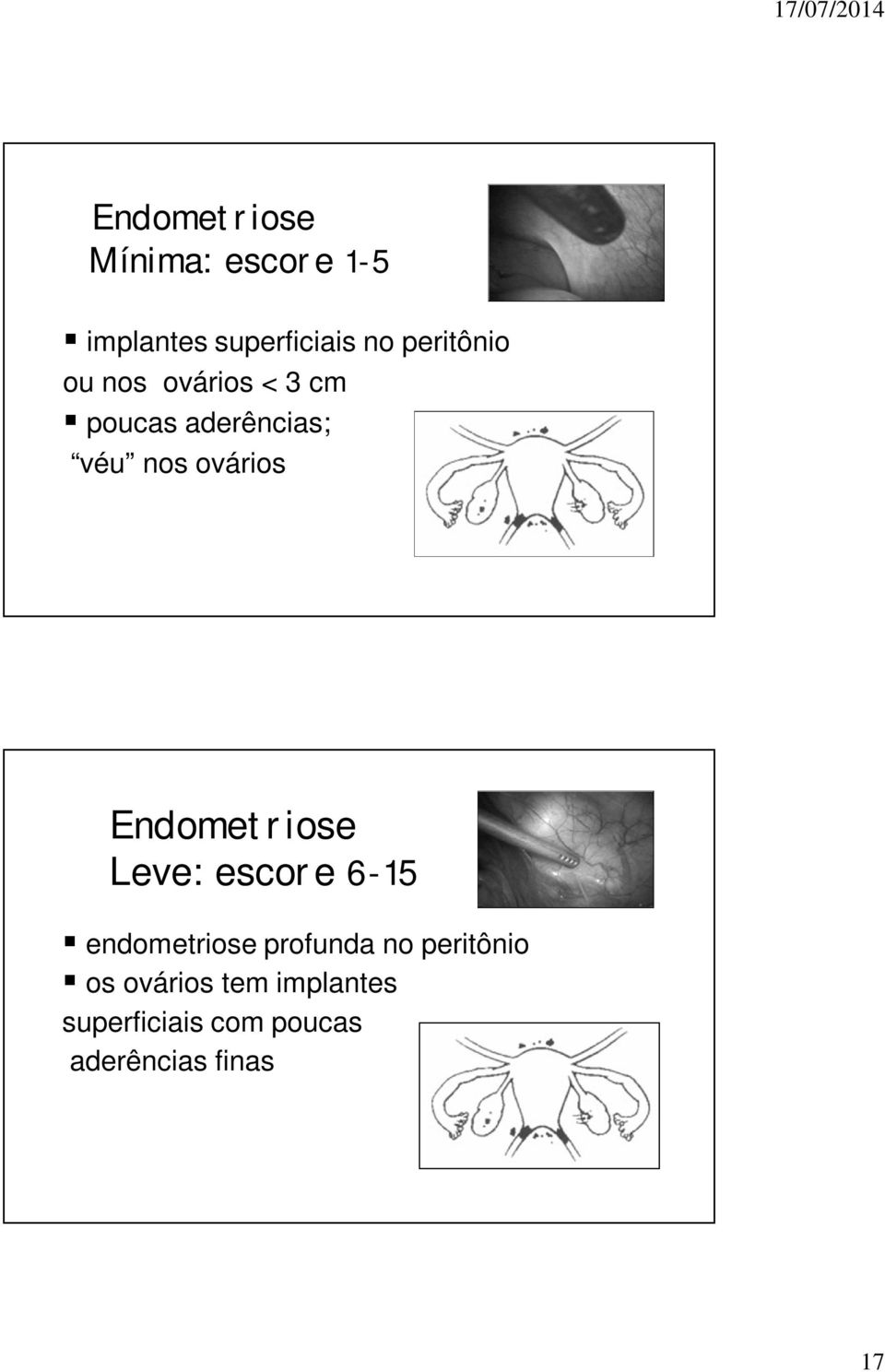 ovários Endometriose Leve: escore 6-15 endometriose profunda no