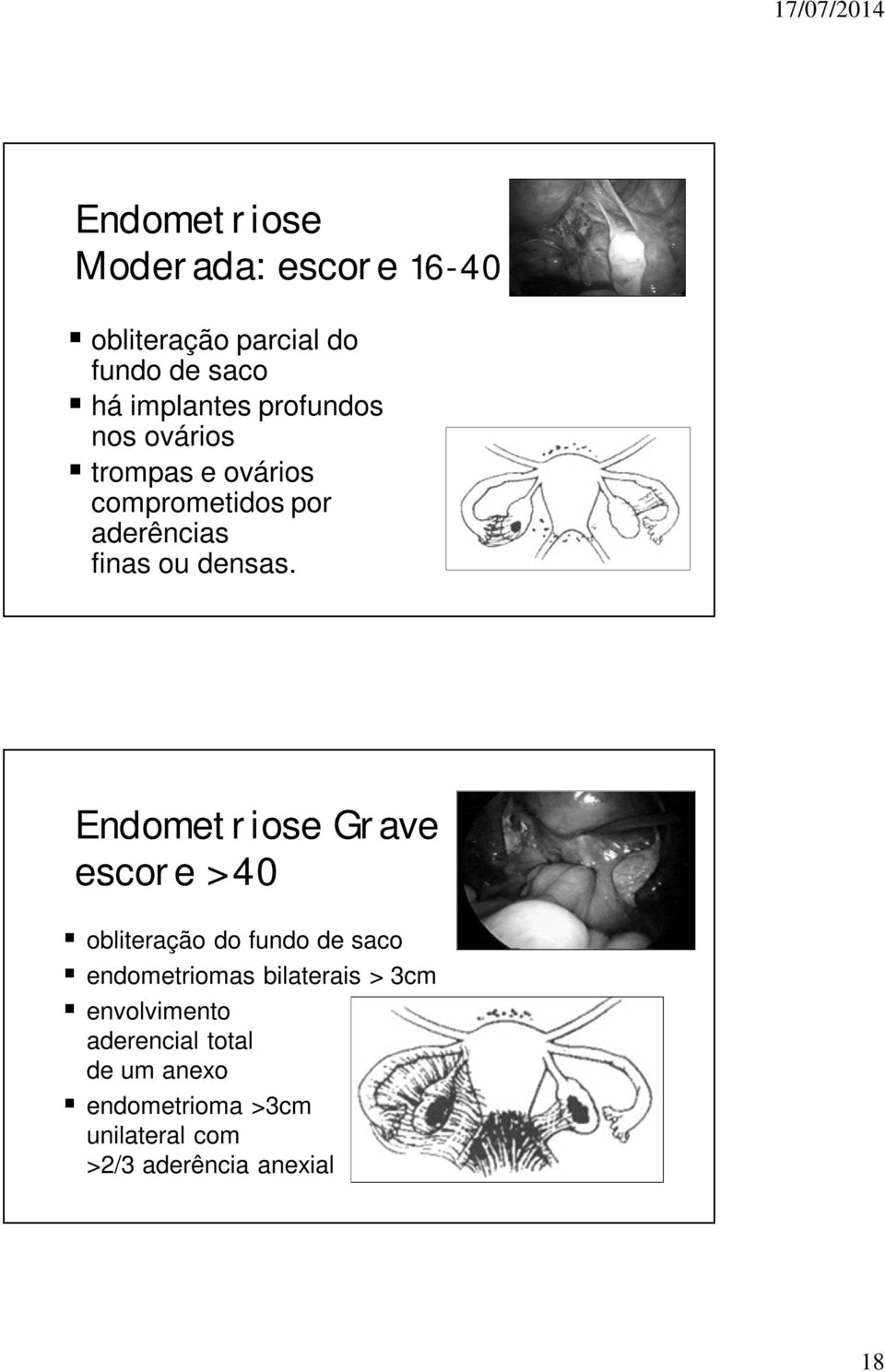 Endometriose Grave escore > 40 obliteração do fundo de saco endometriomas bilaterais > 3cm