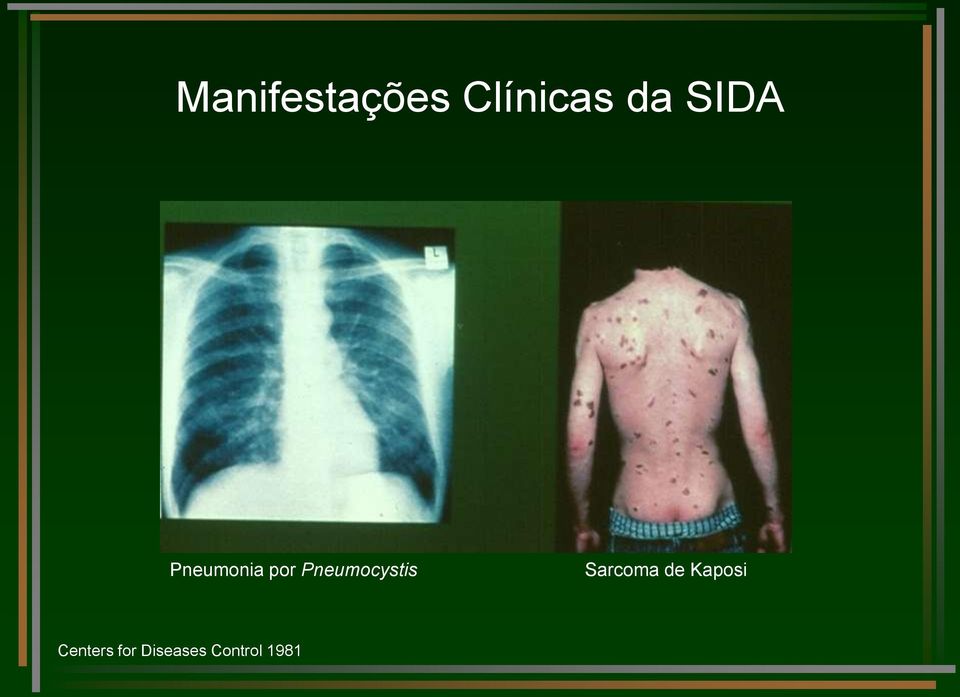 Pneumocystis Sarcoma de