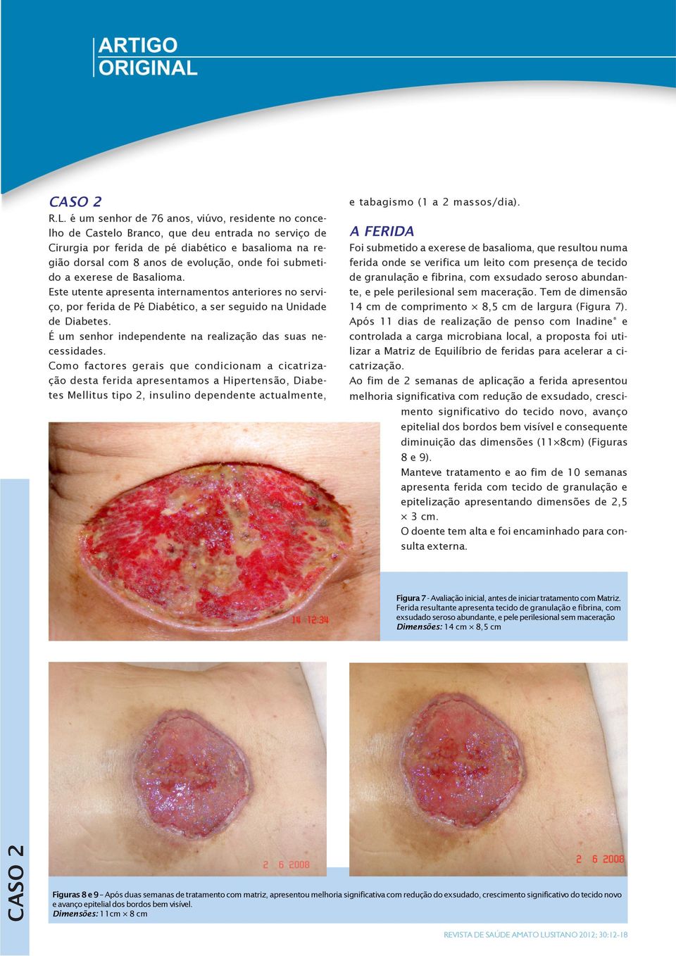 submetido a exerese de Basalioma. Este utente apresenta internamentos anteriores no serviço, por ferida de Pé Diabético, a ser seguido na Unidade de Diabetes.