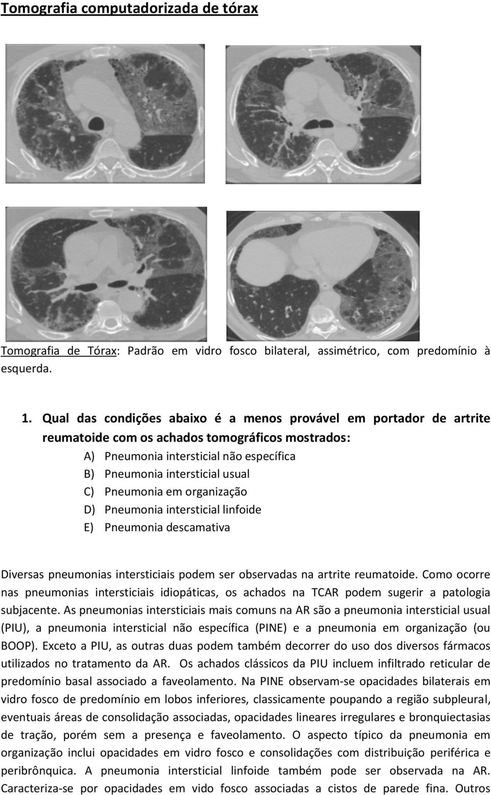 Pneumonia em organização D) Pneumonia intersticial linfoide E) Pneumonia descamativa Diversas pneumonias intersticiais podem ser observadas na artrite reumatoide.