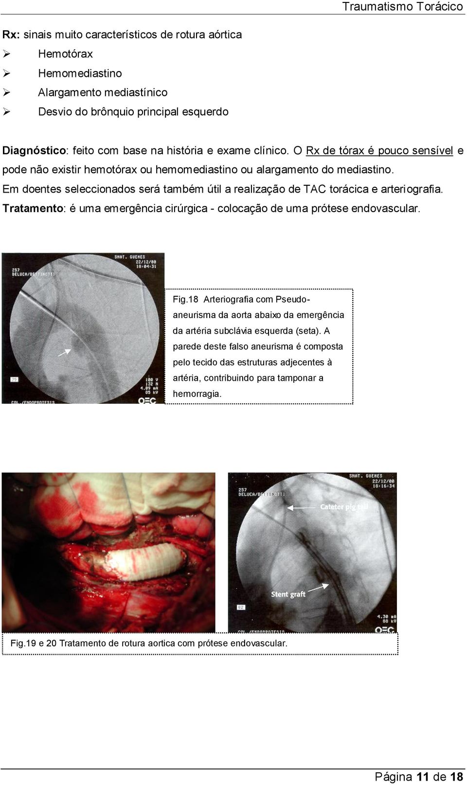 Tratamento: é uma emergência cirúrgica - colocação de uma prótese endovascular. Fig.18 Arteriografia com Pseudoaneurisma da aorta abaixo da emergência da artéria subclávia esquerda (seta).