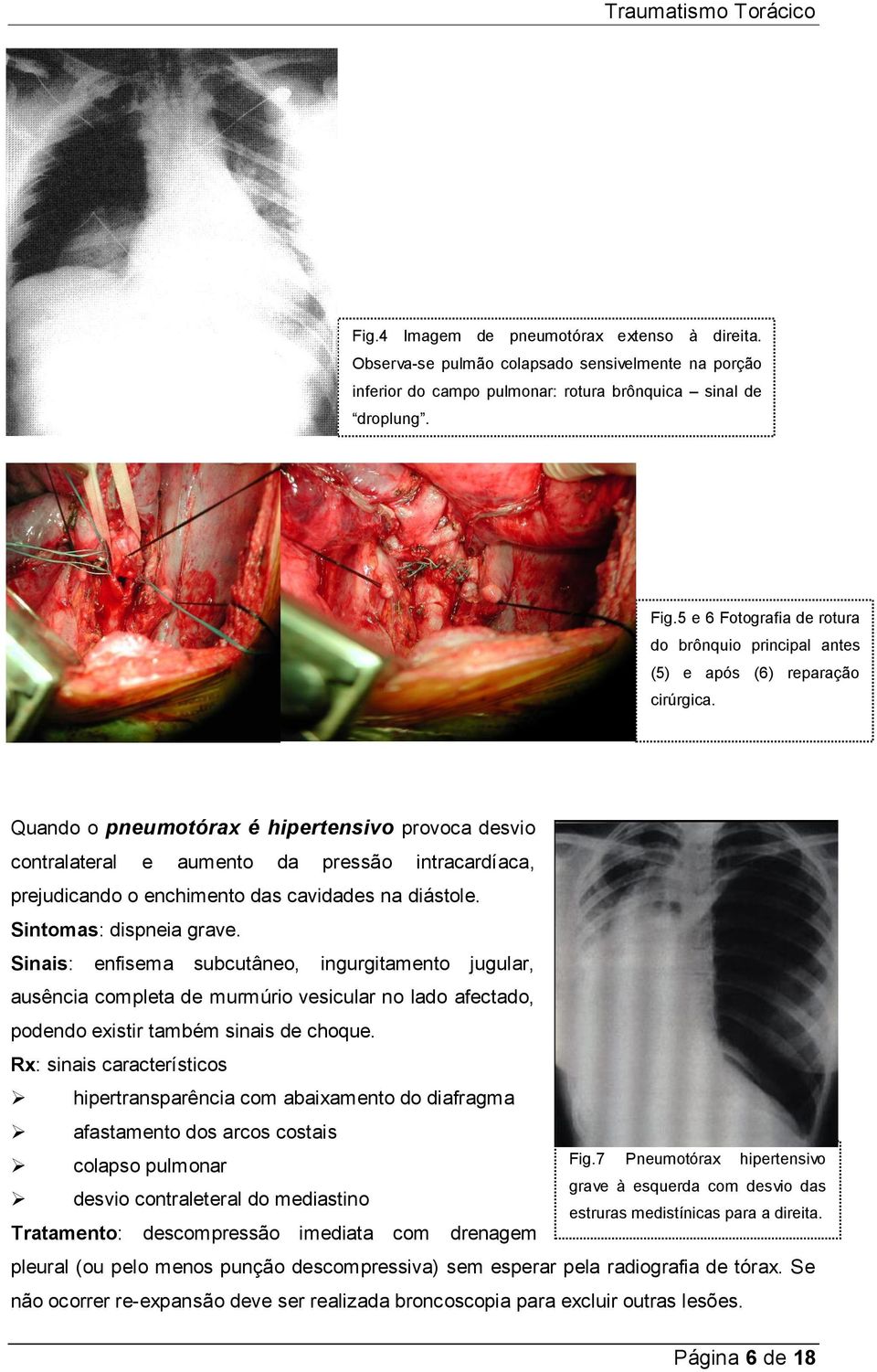 Quando o pneumotórax é hipertensivo provoca desvio contralateral e aumento da pressão intracardíaca, prejudicando o enchimento das cavidades na diástole. Sintomas: dispneia grave.