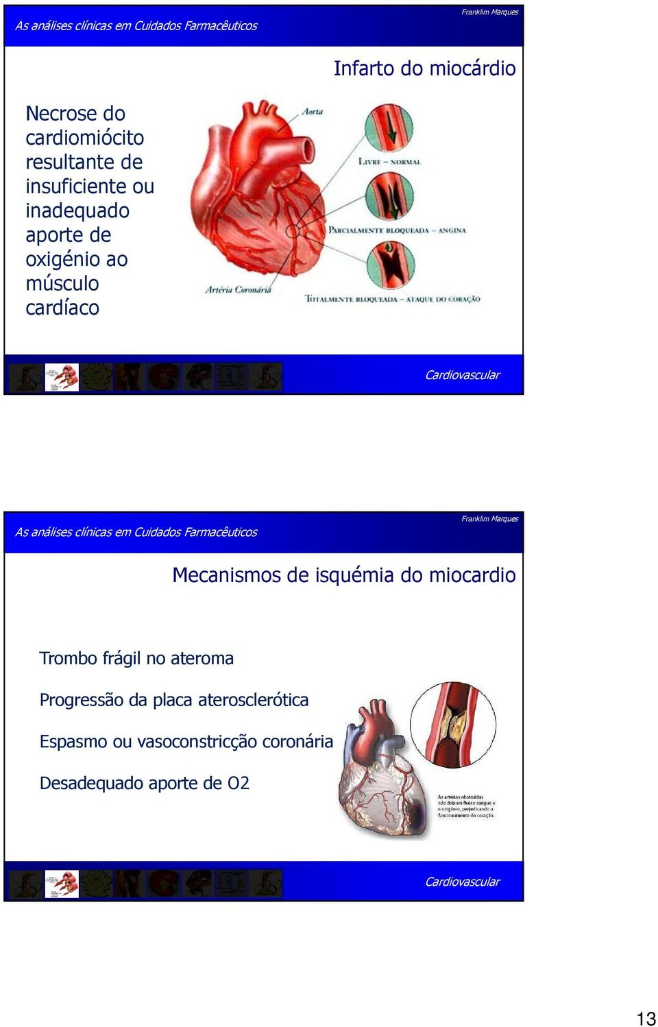 Mecanismos de isquémia do miocardio Trombo frágil no ateroma Progressão