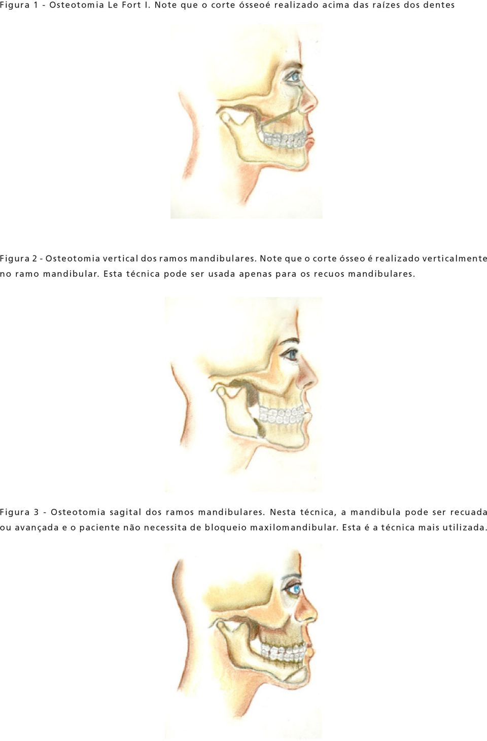 Note que o corte ósseo é realizado verticalmente no ramo mandibular.