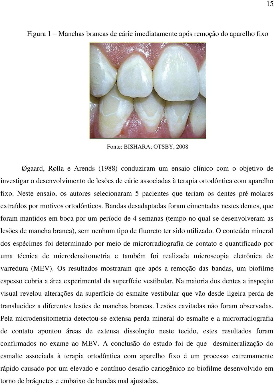 Neste ensaio, os autores selecionaram 5 pacientes que teriam os dentes pré-molares extraídos por motivos ortodônticos.