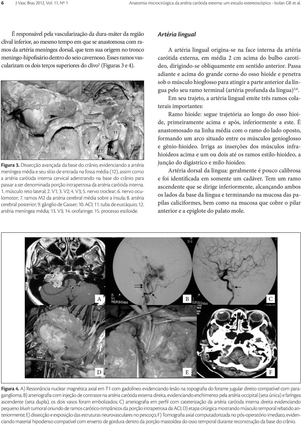 dentro do seio cavernoso. Esses ramos vascularizam os dois terços superiores do clivo 5 (Figuras 3 e 4). Figura 3.