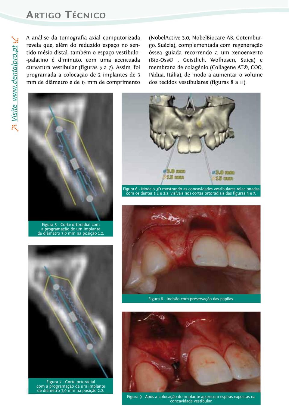 0, NobelBiocare AB, Gotemburgo, Suécia), complementada com regeneração óssea guiada recorrendo a um xenoenxerto (Bio-Oss, Geistlich, Wolhusen, Suiça) e membrana de colagénio (Collagene AT, COO,