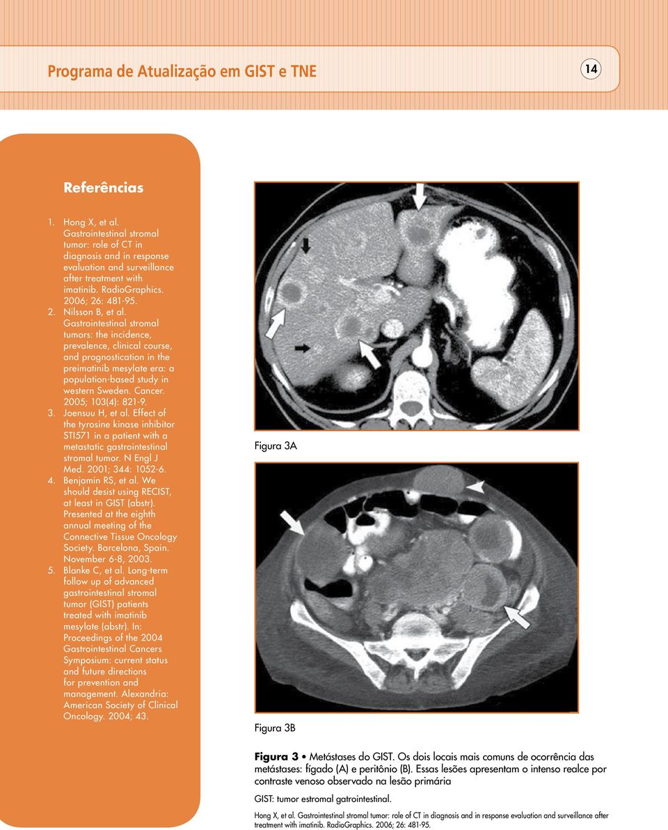 Gastrointestinal stromal tumors: the incidence, prevalence, clinical course, and prognostication in the preimatinib mesylate era: a population-based study in western Sweden. Cancer.