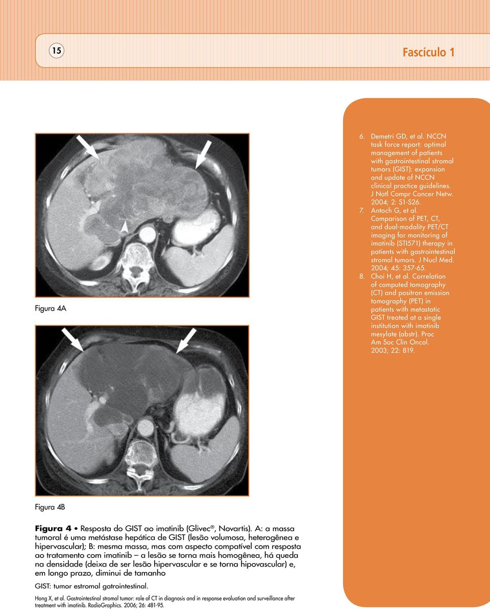 2004; 2: S1-S26. 7. Antoch G, et al. Comparison of PET, CT, and dual-modality PET/CT imaging for monitoring of imatinib (STI571) therapy in patients with gastrointestinal stromal tumors. J Nucl Med.