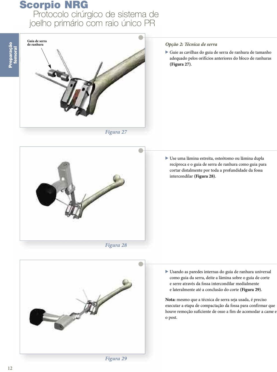 Figura 27 > Use uma lâmina estreita, osteótomo ou lâmina dupla recíproca e o guia de serra de ranhura como guia para cortar distalmente por toda a profundidade da fossa intercondilar (Figura 28).