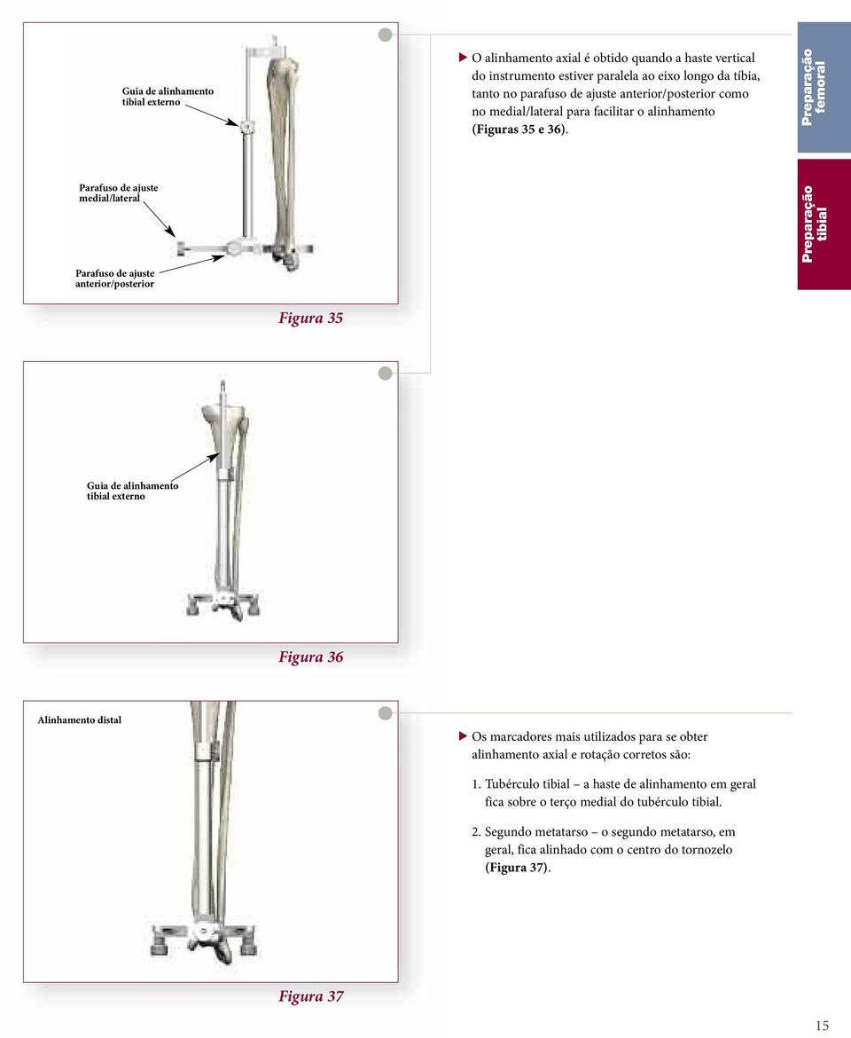 femoral Parafuso de ajuste medial/lateral Parafuso de ajuste anterior/posterior tibial Figura 35 Guia de alinhamento tibial externo Figura 36 Alinhamento distal > Os marcadores mais