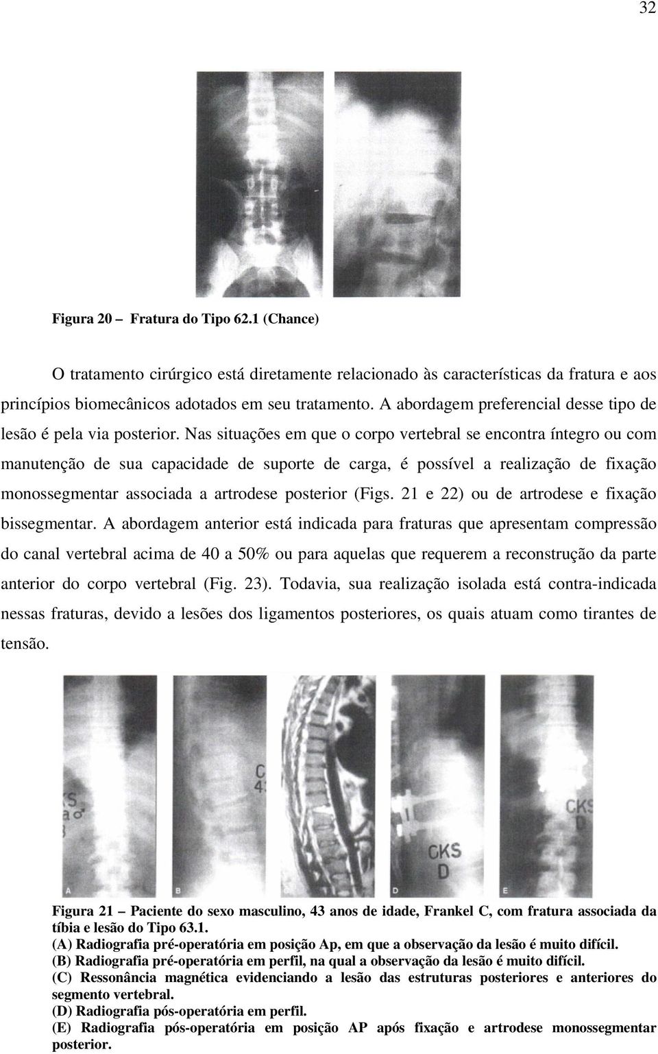 Nas situações em que o corpo vertebral se encontra íntegro ou com manutenção de sua capacidade de suporte de carga, é possível a realização de fixação monossegmentar associada a artrodese posterior