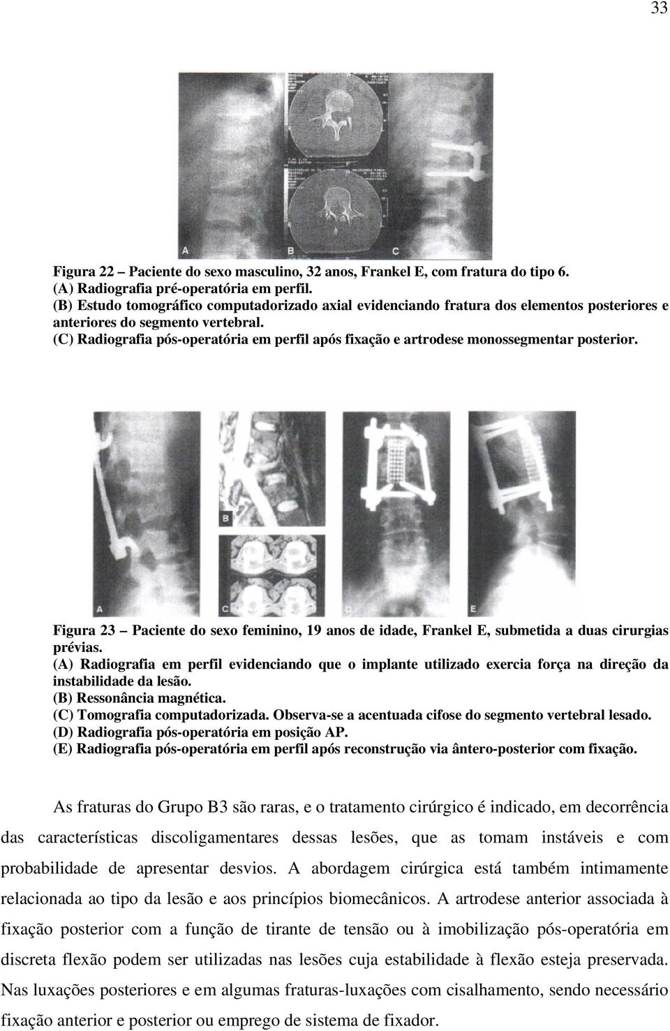 (C) Radiografia pós-operatória em perfil após fixação e artrodese monossegmentar posterior. Figura 23 Paciente do sexo feminino, 19 anos de idade, Frankel E, submetida a duas cirurgias prévias.