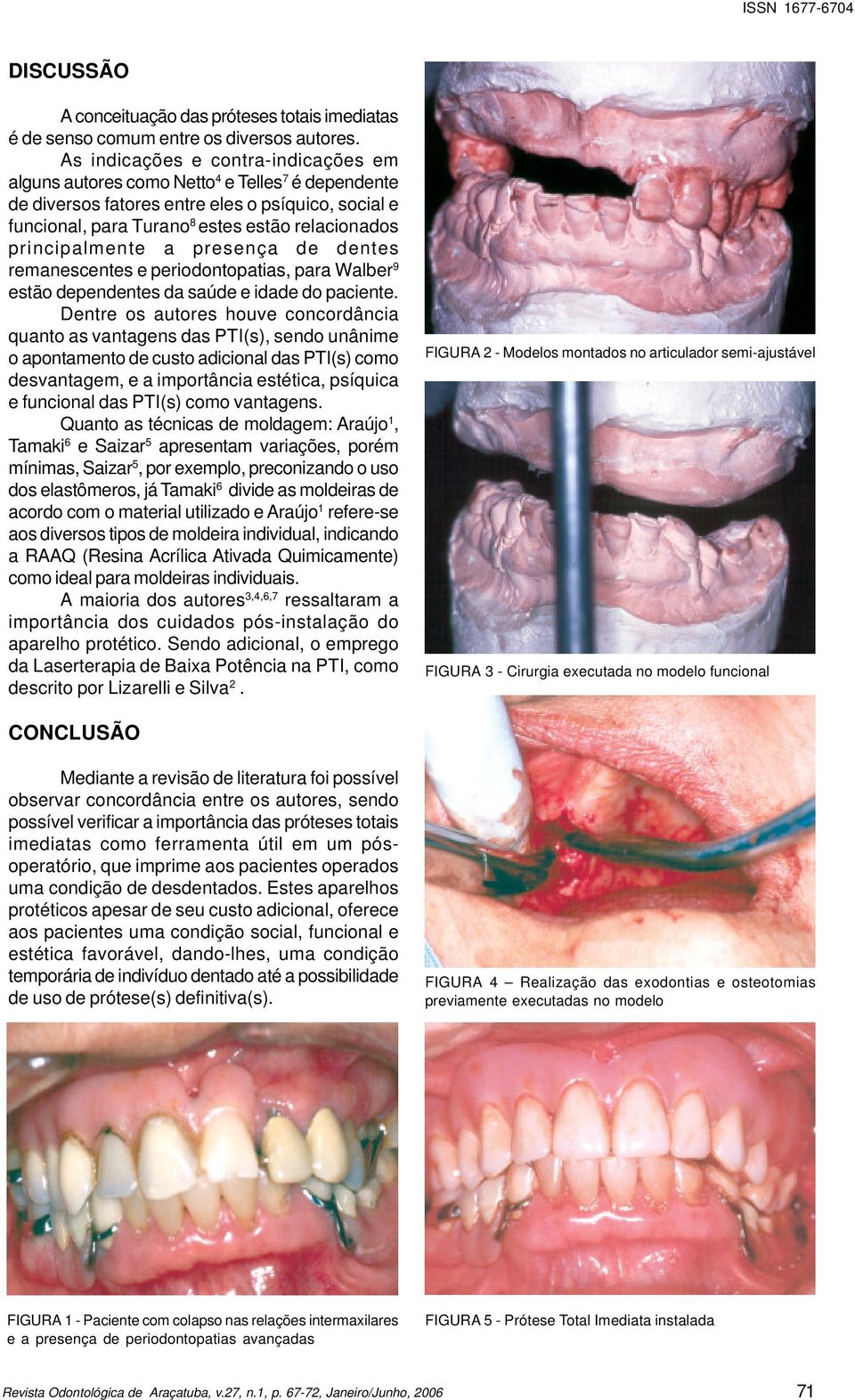 principalmente a presença de dentes remanescentes e periodontopatias, para Walber 9 estão dependentes da saúde e idade do paciente.