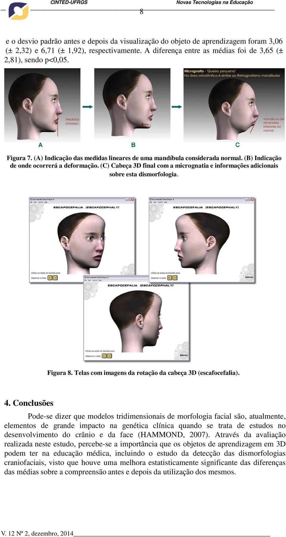 (C) Cabeça 3D final com a micrognatia e informações adicionais sobre esta dismorfologia. Figura 8. Telas com imagens da rotação da cabeça 3D (escafocefalia). 4.