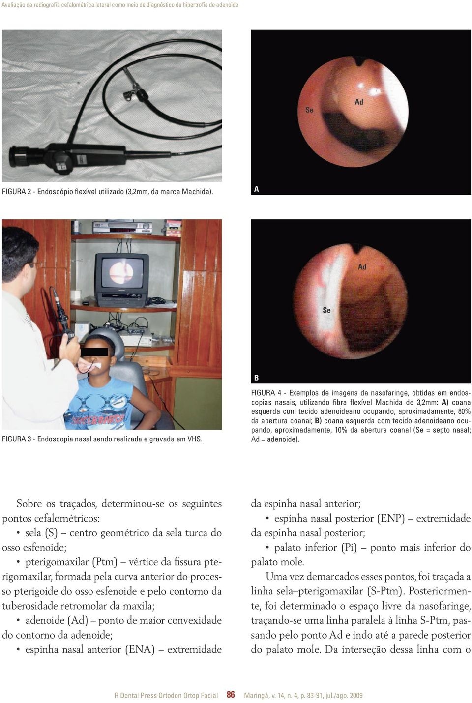 Figura 4 - Exemplos de imagens da nasofaringe, obtidas em endoscopias nasais, utilizando fibra flexível Machida de 3,2mm: A) coana esquerda com tecido adenoideano ocupando, aproximadamente, 80% da