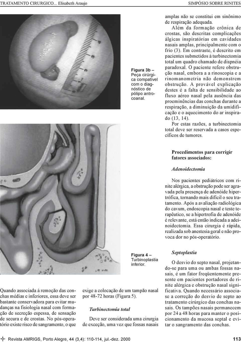 Em contraste, é descrito em pacientes submetidos à turbinectomia total um quadro chamado de dispnéia paradoxal.