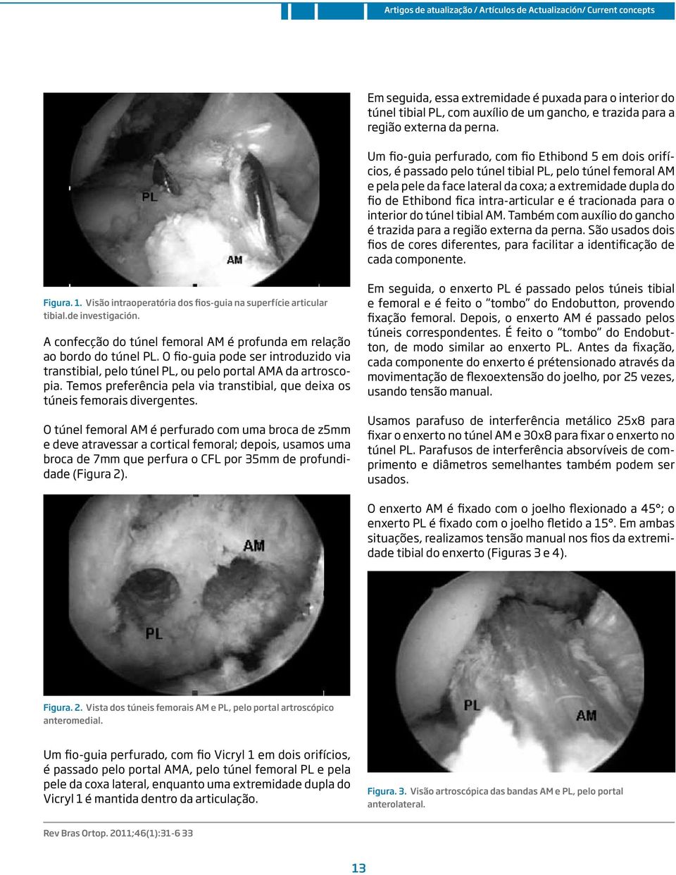 intra-articular e é tracionada para o interior do túnel tibial AM. Também com auxílio do gancho é trazida para a região externa da perna.