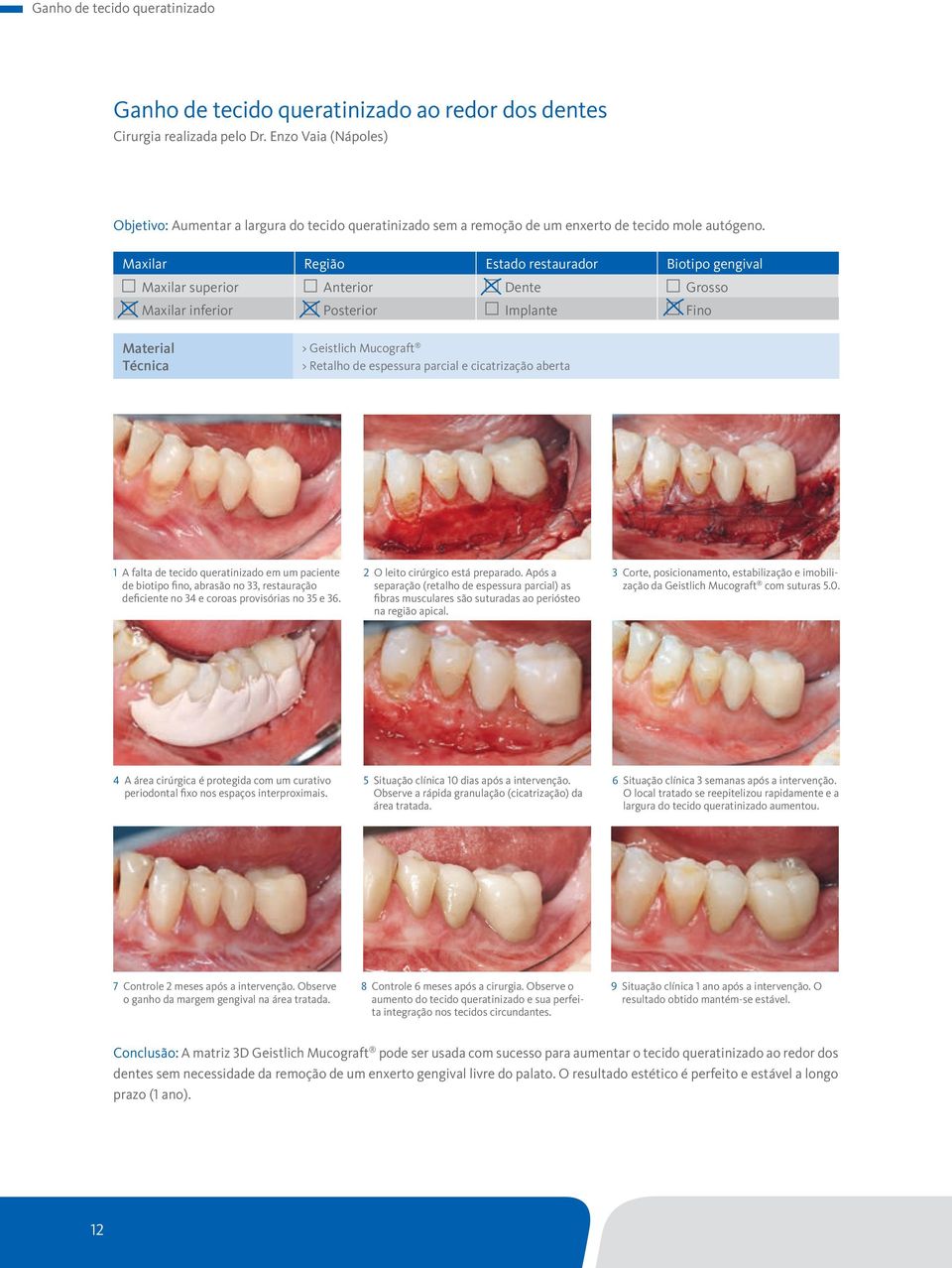 Maxilar Região Estado restaurador Biotipo gengival Maxilar superior Anterior Dente Grosso Maxilar inferior Posterior Implante Fino Material Técnica > Geistlich Mucograft > Retalho de espessura