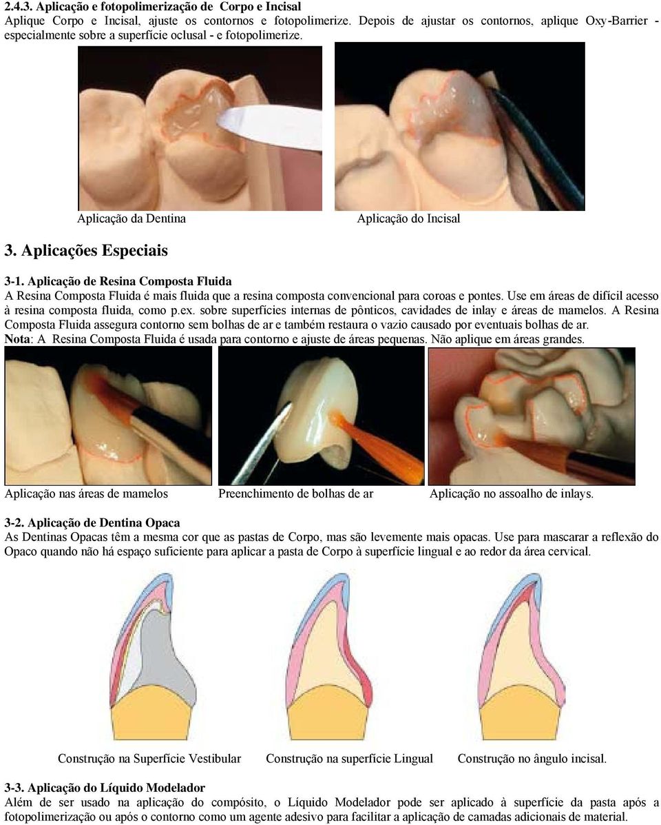 Aplicação de Resina Composta Fluida A Resina Composta Fluida é mais fluida que a resina composta convencional para coroas e pontes. Use em áreas de difícil acesso à resina composta fluida, como p.ex.