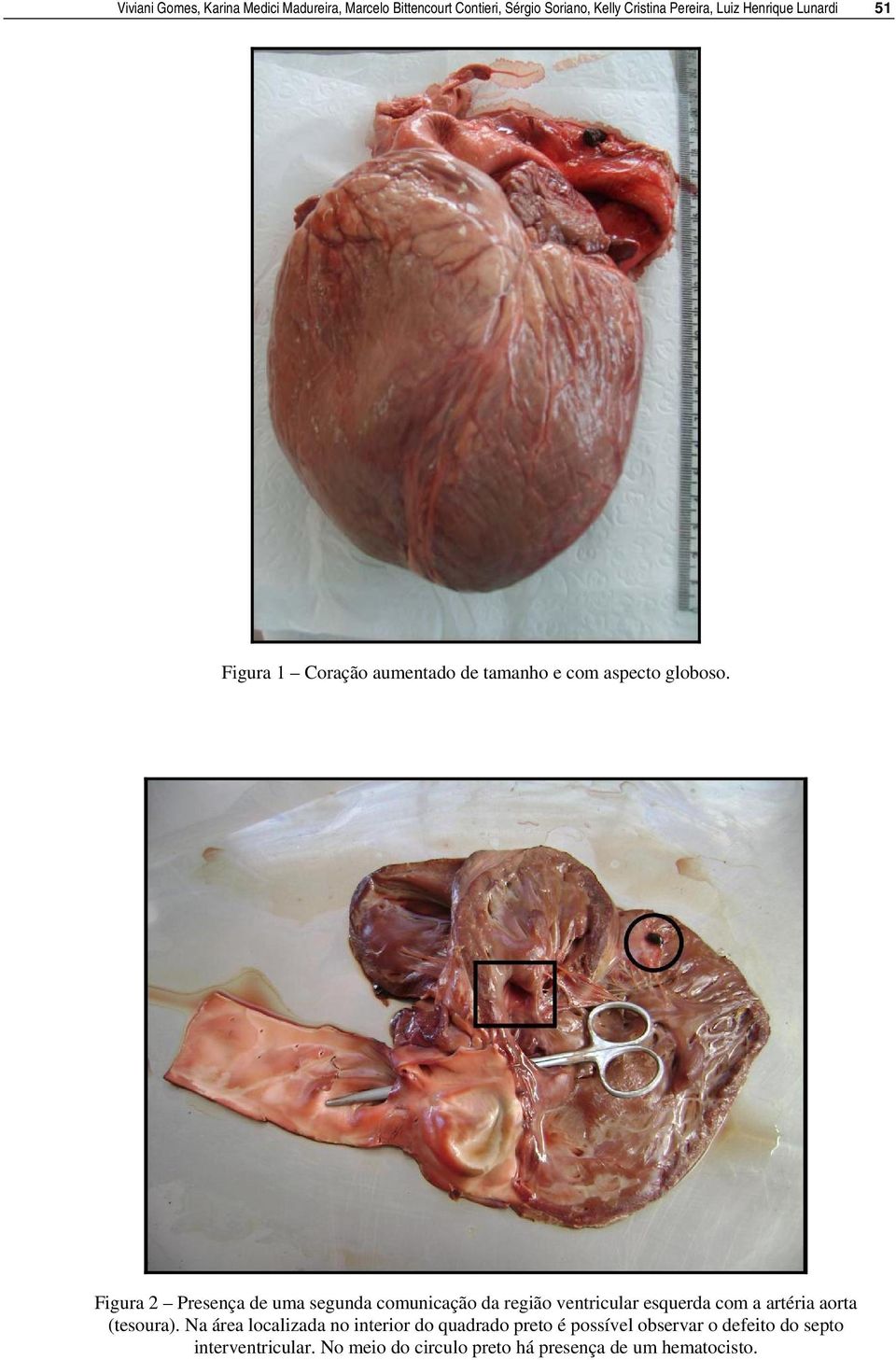 Figura 2 Presença de uma segunda comunicação da região ventricular esquerda com a artéria aorta (tesoura).