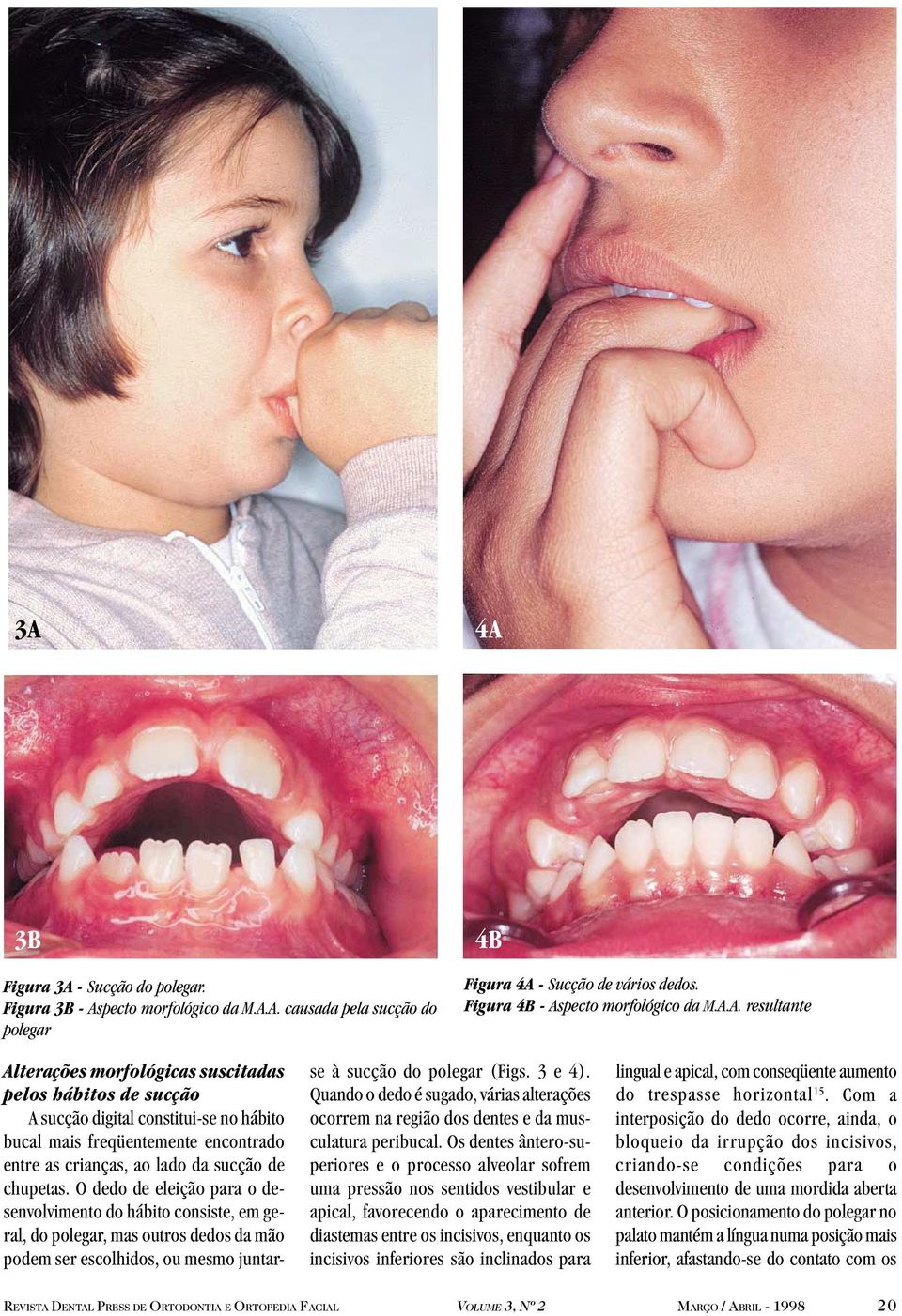 Quando o dedo é sugado, várias alterações ocorrem na região dos dentes e da musculatura peribucal.