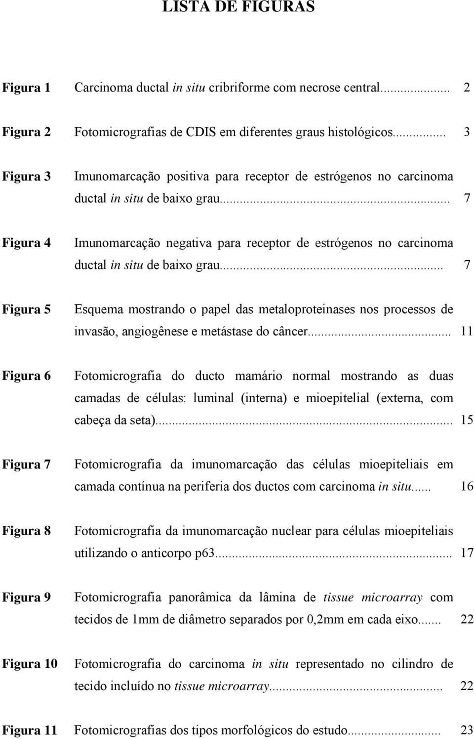 .. 7 Figura 4 Imunomarcação negativa para receptor de estrógenos no carcinoma ductal in situ de baixo grau.