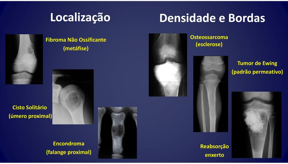 Tumor de Ewing (padrão permeativo) Cisto Solitário