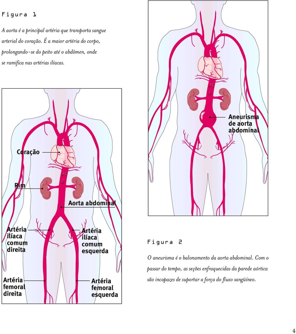 Aneurisma de aorta abdominal Coração Rim Aorta abdominal Artéria ilíaca comum direita Artéria femoral direita Artéria ilíaca comum