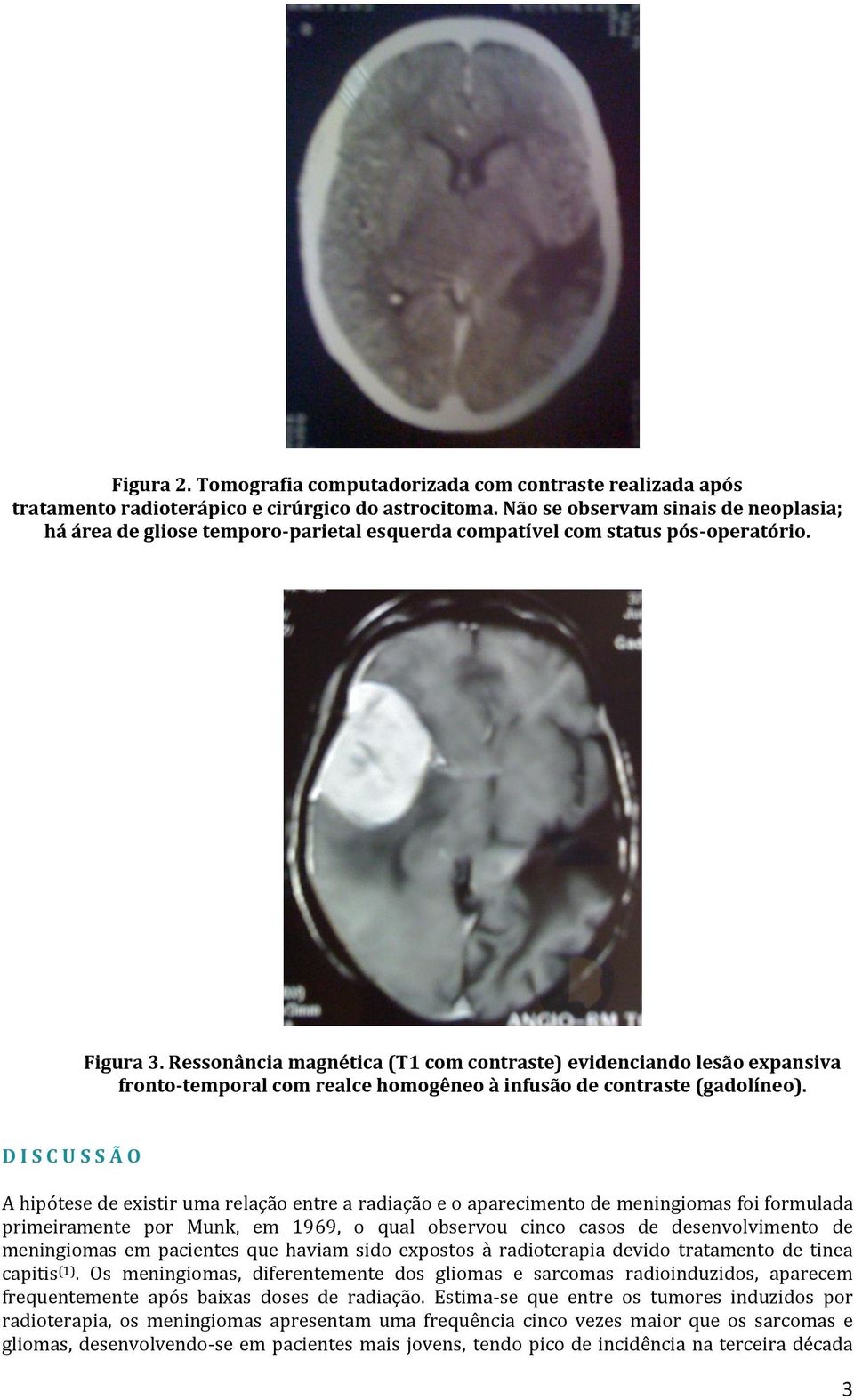 Ressonância magnética (T1 com contraste) evidenciando lesão expansiva fronto-temporal com realce homogêneo à infusão de contraste (gadolíneo).