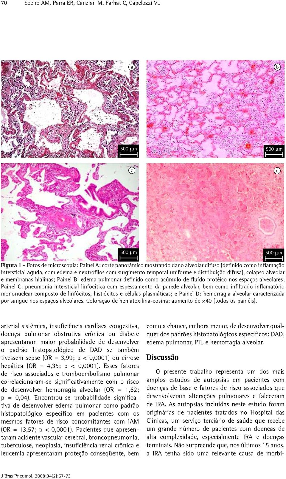 espaços alveolares; Painel C: pneumonia intersticial linfocítica com espessamento da parede alveolar, bem como infiltrado inflamatório mononuclear composto de linfócitos, histiócitos e células