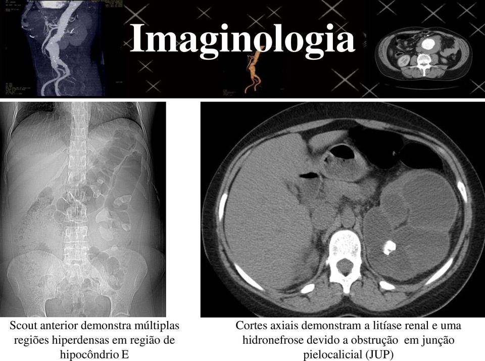 axiais demonstram a litíase renal e uma