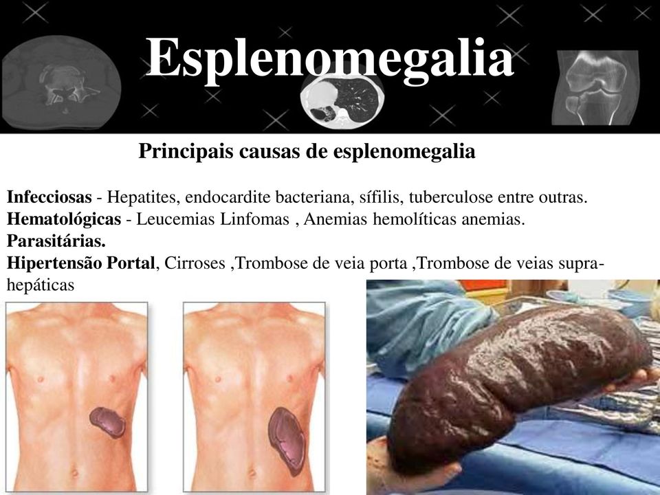 Hematológicas - Leucemias Linfomas, Anemias hemolíticas anemias.