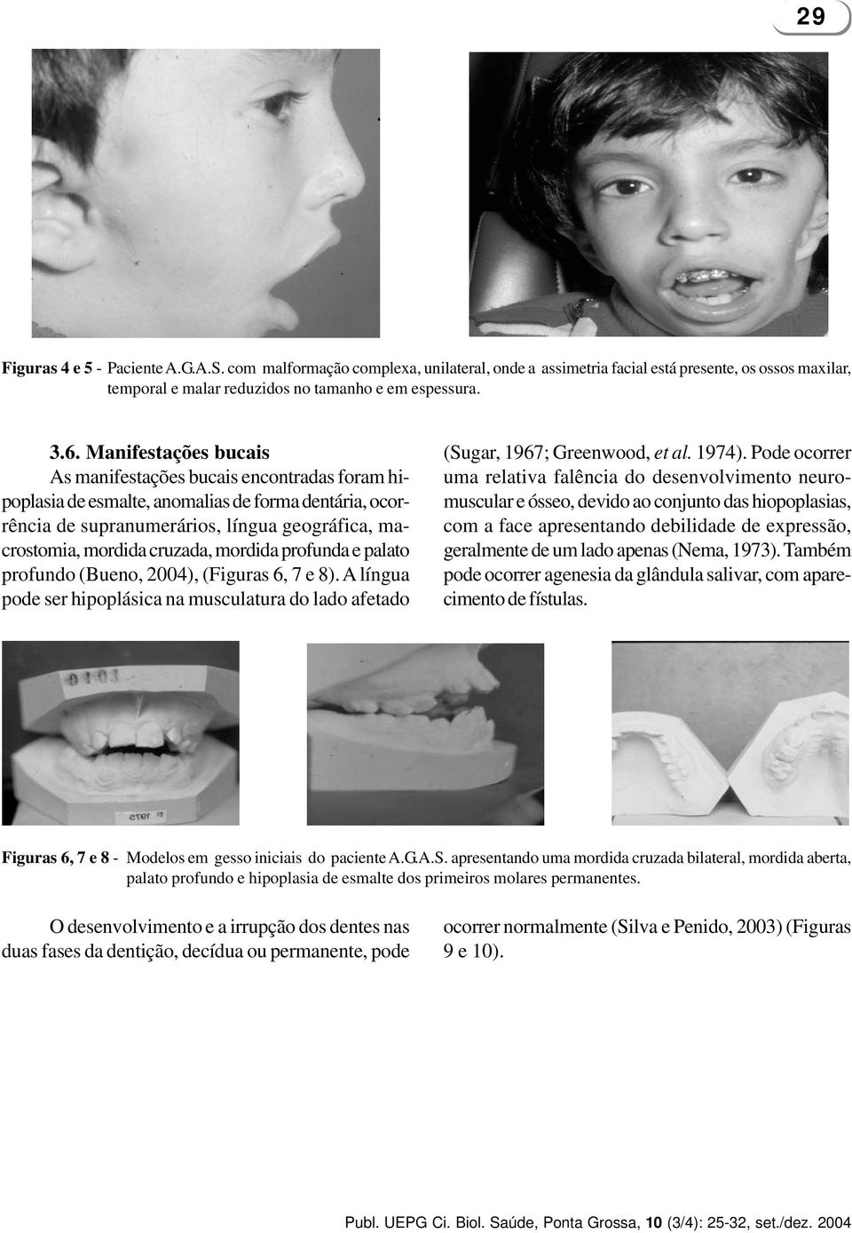 mordida profunda e palato profundo (Bueno, 2004), (Figuras 6, 7 e 8). A língua pode ser hipoplásica na musculatura do lado afetado (Sugar, 1967; Greenwood, et al. 1974).