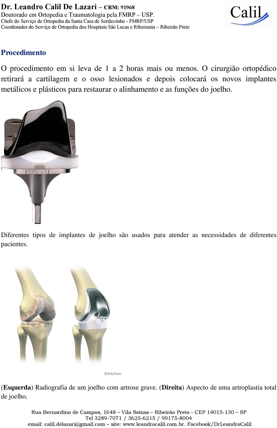 plásticos para restaurar o alinhamento e as funções do joelho.