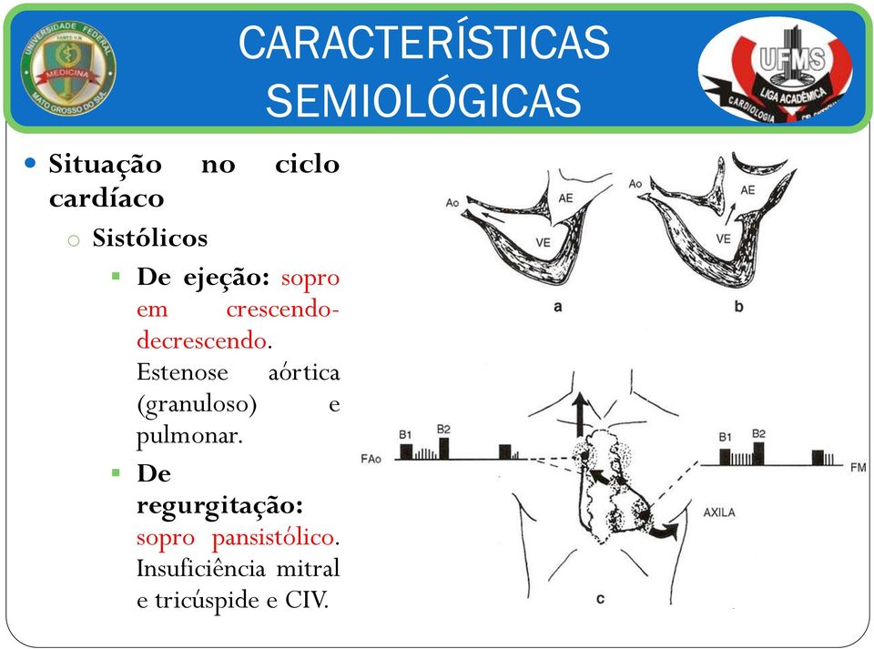 Estenose aórtica (granuloso) e pulmonar.